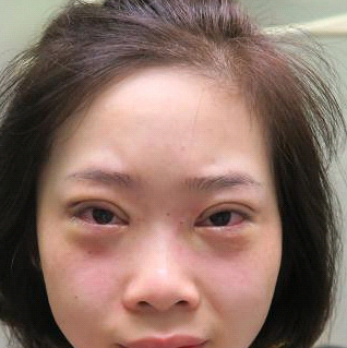 保定安卓貝拉醫(yī)療美容門診部孫大山醫(yī)生做雙眼皮+去眼袋怎么樣？附案例效果對比圖