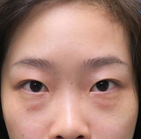 保定安卓貝拉醫(yī)療美容門診部孫大山醫(yī)生做雙眼皮+去眼袋怎么樣？附案例效果對比圖