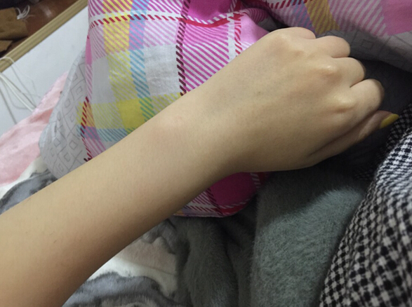 蚌埠市第三人民醫(yī)院燒傷整形科李方奇注射美白針效果怎么樣？安全嗎？附案例