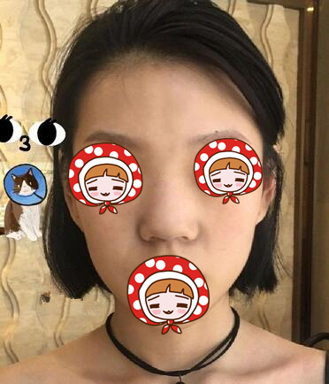 蘇州愛(ài)思特醫(yī)療美容醫(yī)院歪鼻矯正手術(shù)前的效果