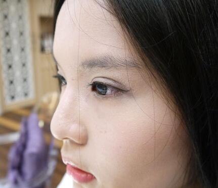 蘇州愛(ài)思特醫(yī)療美容醫(yī)院雙眼皮術(shù)后效果