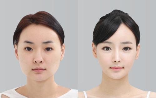 想做歐式雙眼皮，什么是歐式雙眼皮？