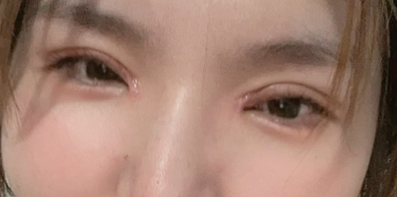 全切雙眼皮好看嗎？做全切雙眼皮手術(shù)需要多長時間？