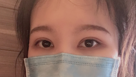 全切雙眼皮會越來越窄嗎？