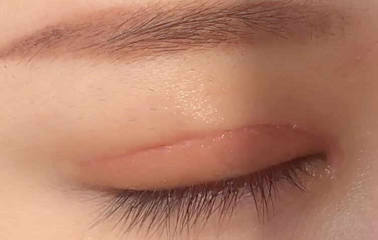 全切雙眼皮多久恢復(fù)？全切開雙眼皮有哪些優(yōu)點？