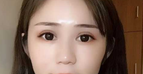 全切雙眼皮會越來越窄嗎？全切雙眼皮消腫的辦法有哪些？