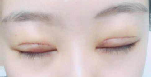 全切雙眼皮術(shù)后會(huì)留疤嗎？