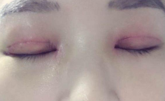 全切雙眼皮不對(duì)稱怎么辦？