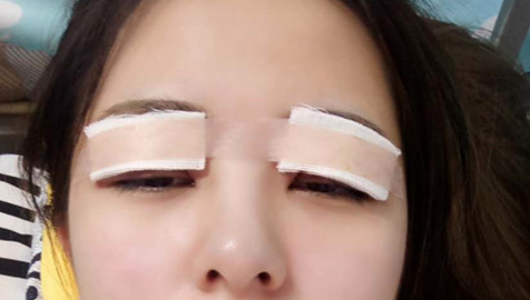 全切雙眼皮怎么恢復(fù)快？