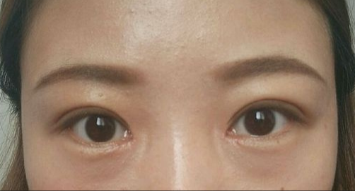 全切雙眼皮能保持多久？