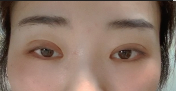 什么是全切雙眼皮？全切雙眼皮的恢復(fù)時(shí)間？