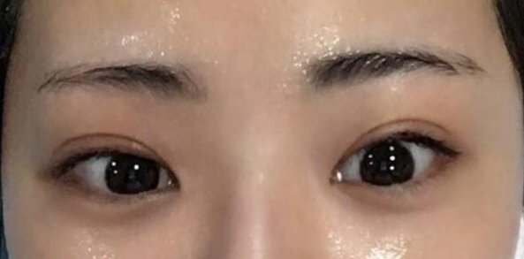 雙眼皮全切的風險有哪些？