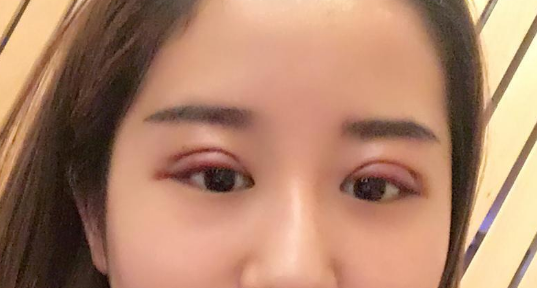 全切雙眼皮好不好？全切雙眼皮多長(zhǎng)時(shí)間恢復(fù)自然？
