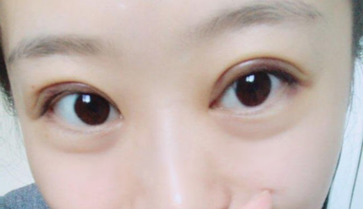 全切雙眼皮手術(shù)時間？全切雙眼皮術(shù)后會反彈嗎？