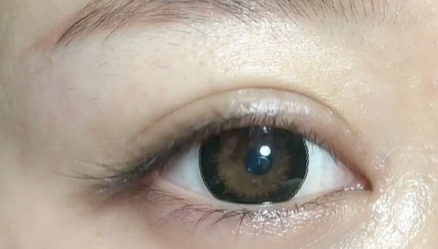 全切雙眼皮失敗可以修復(fù)嗎？