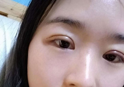 全切雙眼皮大概多少錢？全切雙眼皮多久能恢復？