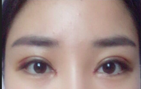 雙眼皮全切術(shù)后注意事項(xiàng)有哪些？