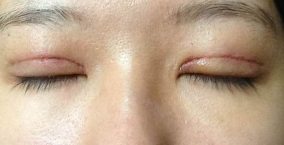 全切雙眼皮到底疼不疼？