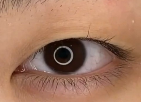 全切雙眼皮幾天可以洗臉？