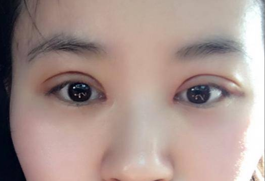 做全切雙眼皮多少錢？