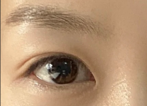 全切雙眼皮效果怎么樣？全切雙眼皮多久自然？
