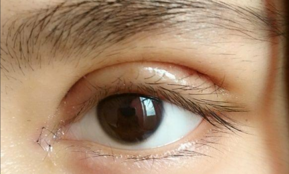 全切雙眼皮會留疤嗎？全切雙眼皮的優(yōu)缺點？