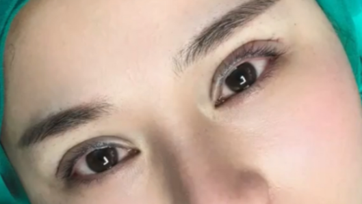 全切雙眼皮會(huì)消失嗎？