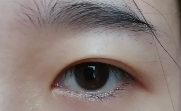 雙眼皮全切好還是韓式三點(diǎn)微創(chuàng)好？