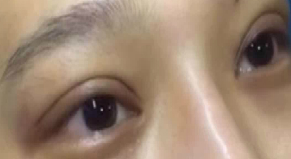埋線雙眼皮大概能保持幾年？