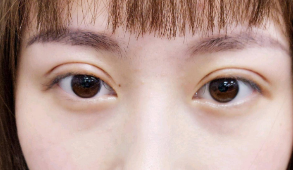 埋線雙眼皮需要拆線嗎？