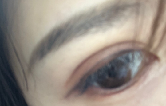 埋線雙眼皮手術(shù)優(yōu)勢有哪些？