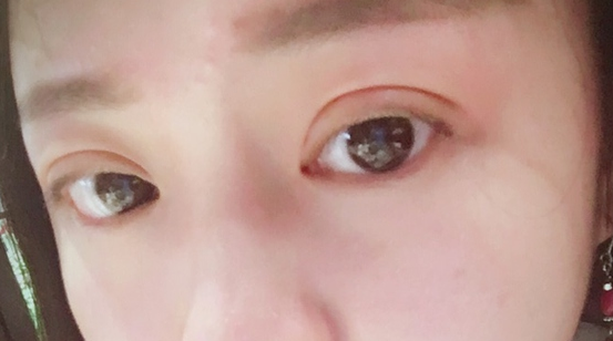 埋線雙眼皮的危害有哪些？