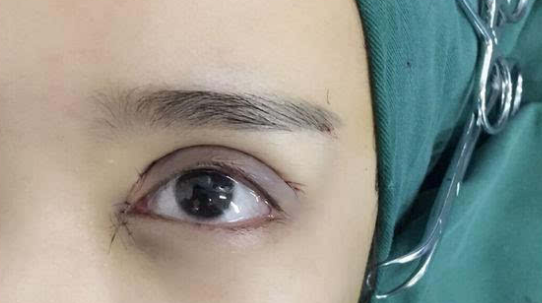 埋線雙眼皮會不會脫線？