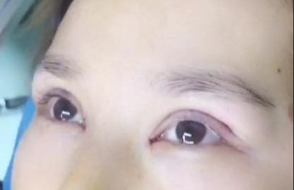 埋線雙眼皮有哪些注意事項？