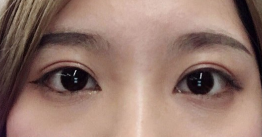 埋線雙眼皮幾天可以碰水？