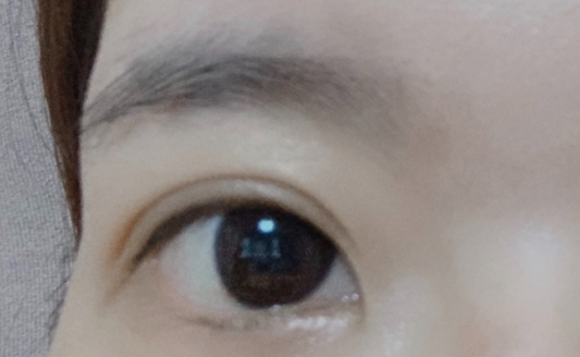 雙眼皮埋線大概多久恢復？