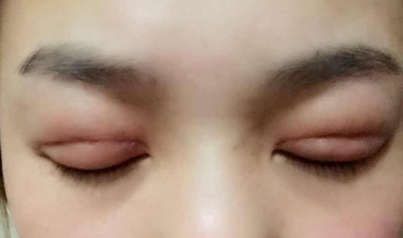埋線雙眼皮幾天能消腫？