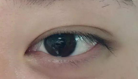 埋線雙眼皮有沒有危害？