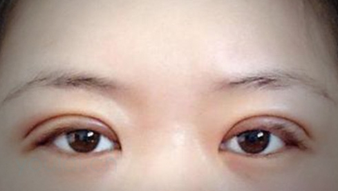定點(diǎn)雙眼皮幾天能恢復(fù)好？定點(diǎn)做雙眼皮多少錢(qián)？
