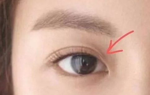 定點雙眼皮一般多少錢？