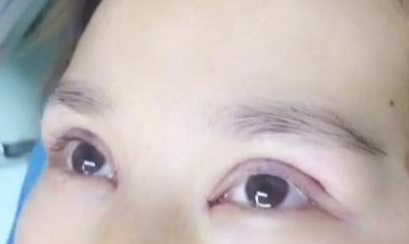 定點(diǎn)雙眼皮手術(shù)效果自然嗎？定點(diǎn)雙眼皮失敗怎么修復(fù)？