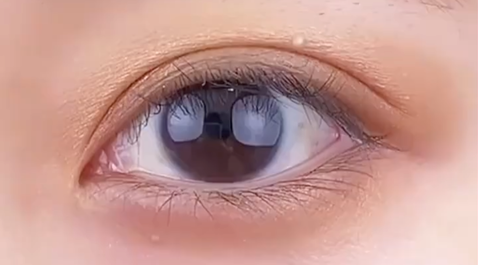 定點(diǎn)雙眼皮多少錢？