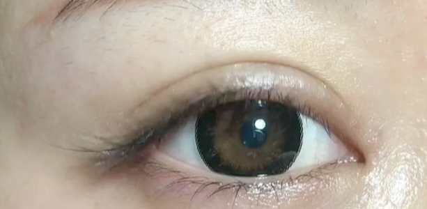 什么是雙眼皮定點？定點雙眼皮多久恢復(fù)？