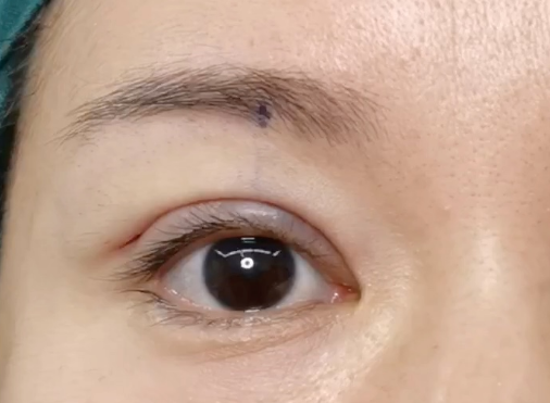 割雙眼皮后有危害嗎？