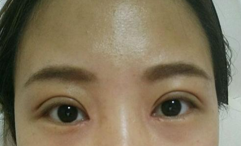 定點雙眼皮會腫嗎？定點雙眼皮會有疤痕嗎？