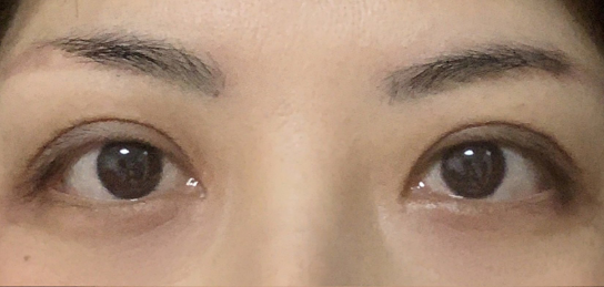 定點(diǎn)雙眼皮會(huì)腫嗎？