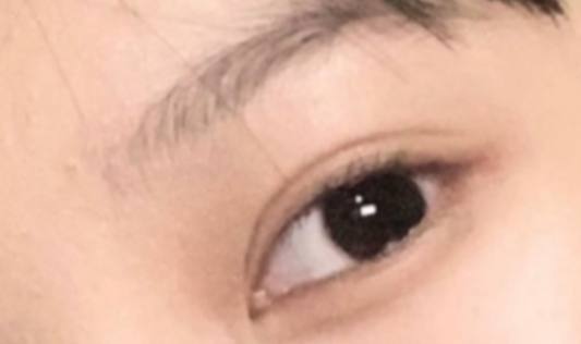 割雙眼皮恢復(fù)需要多久？