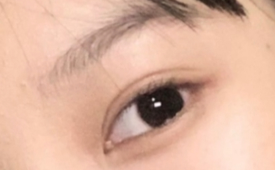 做雙眼皮效果能保持多久？做雙眼皮要冰敷多久？