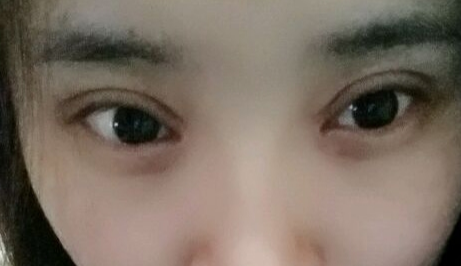 開(kāi)眼角疼嗎？開(kāi)眼角術(shù)后會(huì)留疤的原因有哪些？