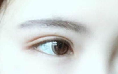 開眼角的恢復期多長？開眼角的后遺癥都有什么？